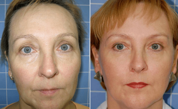 Before and after the rejuvenation process