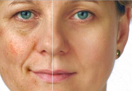 Rejuvenation result