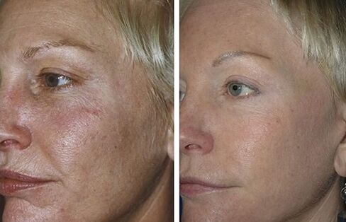 Fractional laser rejuvenation before and after photos