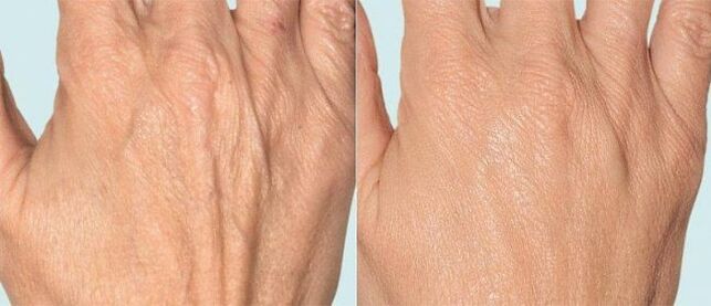 Hand skin before and after fractional therapy