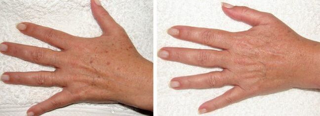 Result of removing age spots on hands